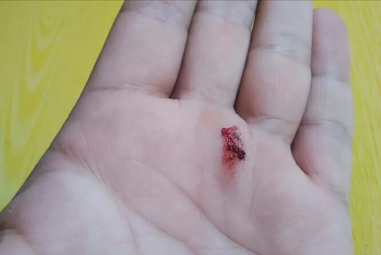用手拍打蚊子的危害(拍蚊子的危害)插图2 用手拍打蚊子的危害(拍蚊子的危害)插图2